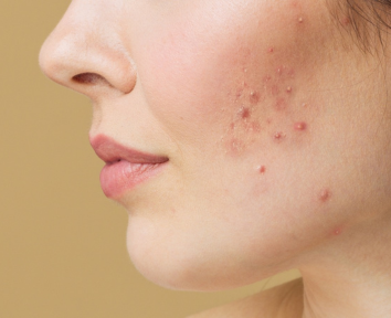 Acne Scar Treatment