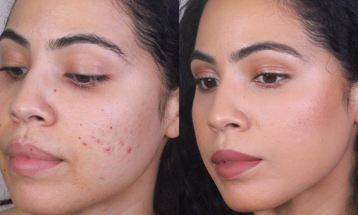 Acne & Acne Scar Treatment